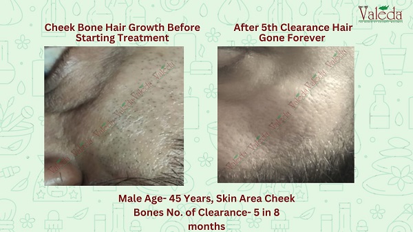Valeda Skin  Hair Clinic in Greater Kailash 1 Delhi  Book Appointment  View Contact Number Feedbacks Address  Dr Seema Bali