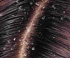 What is the dandruff treatment duration?